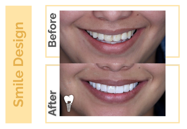 Best Smile Design in Guadalajara Mexico