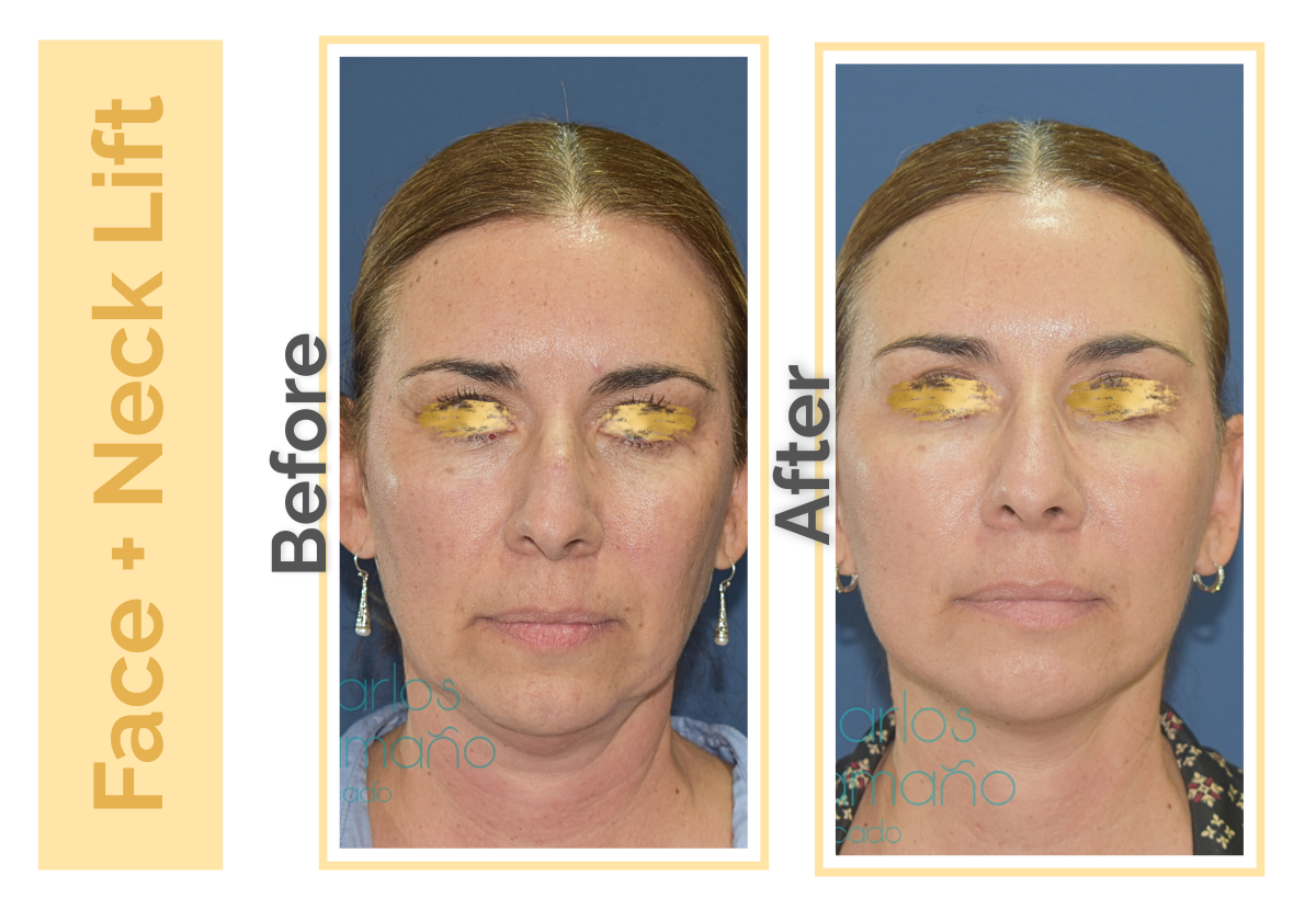 Facelift   Neck Lift in Guadalajara Mexico