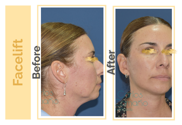 Facelift  Facial Liposculpture  Neck Lift in Guadalajara Mexico