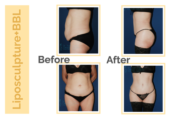 Liposculpture, BBL in Guadalajara Mexico 