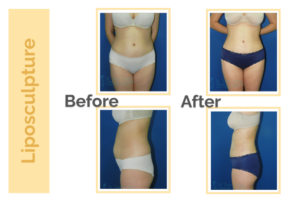 Liposculpture-Lipo in Guadalajara Mexico  (1)