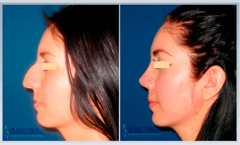 Plastic surgery in Guadalajara