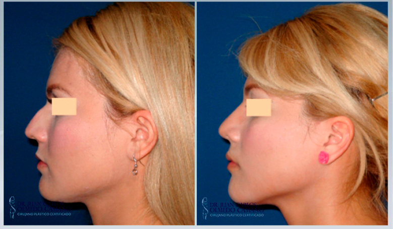 Rhinoplasty in Guadalajara