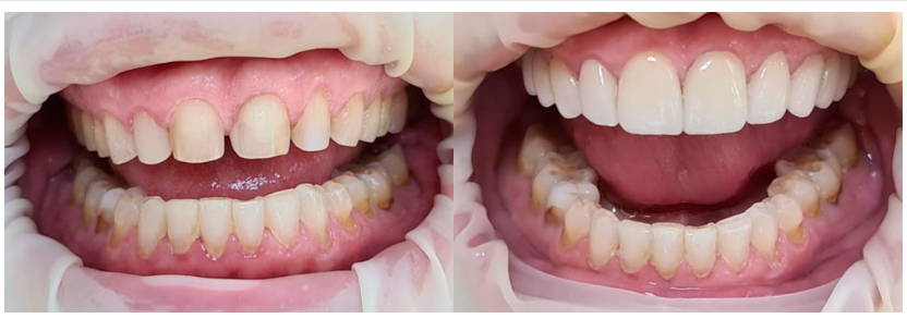 Dental veneers in Guadalajara
